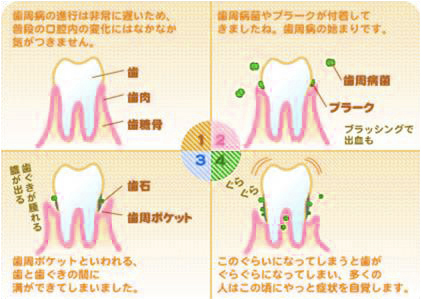 歯周病イメージ