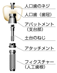 図解：インプラント